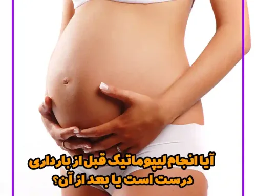 آیا انجام لیپوماتیک قبل از بارداری درست است یا بعد از آن؟