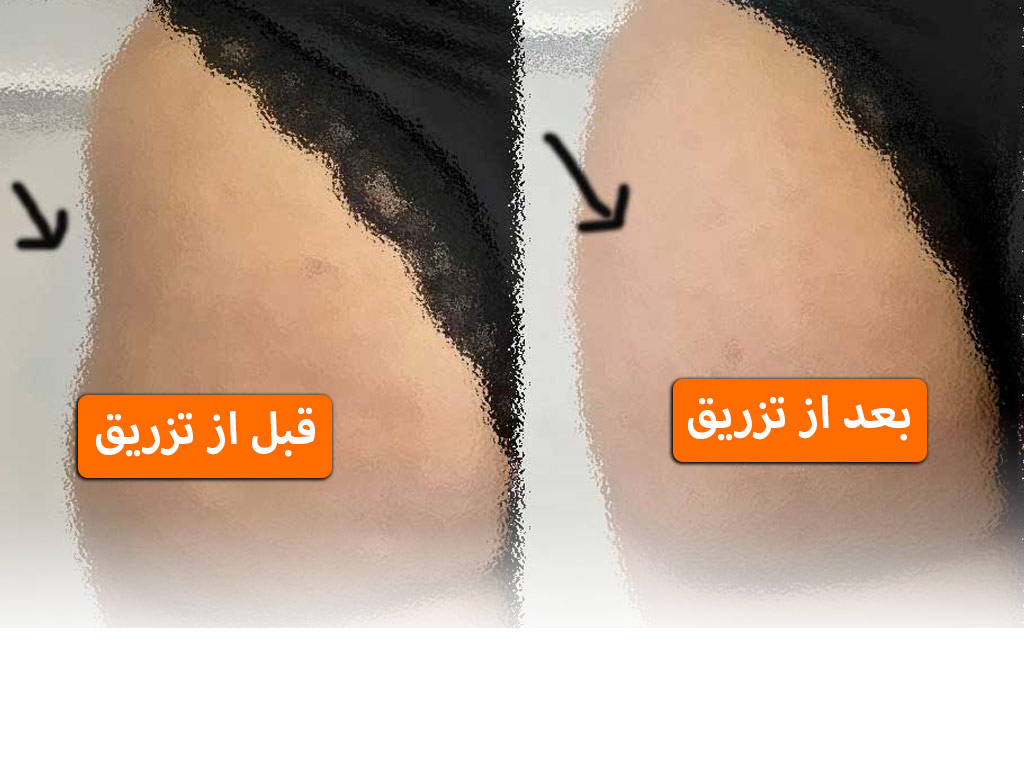 ماندگاری فیلر بیشتره یا چربی + ماندگاری فیلر بادی + تزریق چربی به هیپ دیپ
